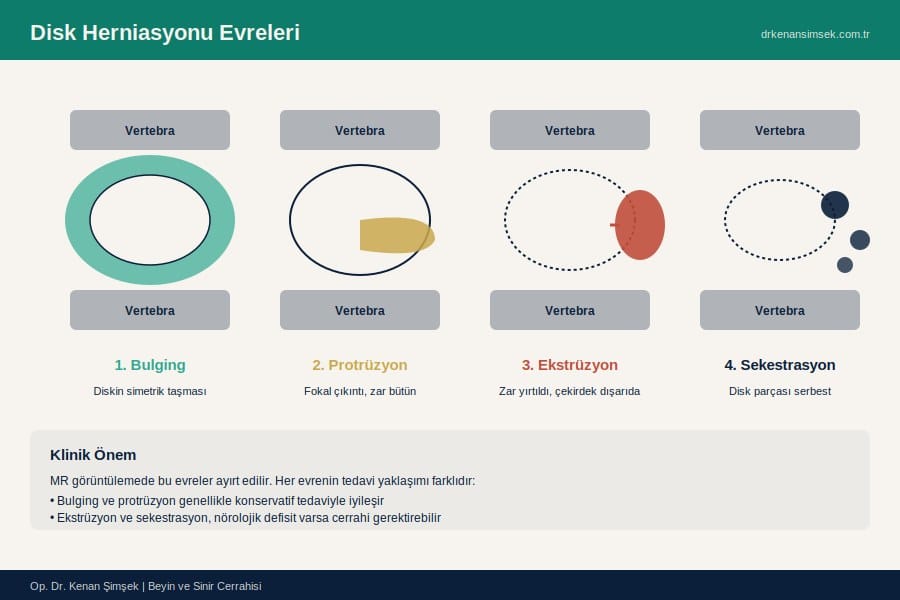 Disk Herniasyonunun Dört Evresi: Bulging, Protrüzyon, Ekstrüzyon, Sekestrasyon